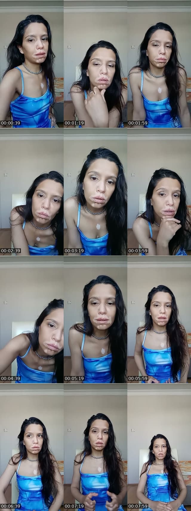 insta reelsime beğeni yorum takp - @vitiligo.babe